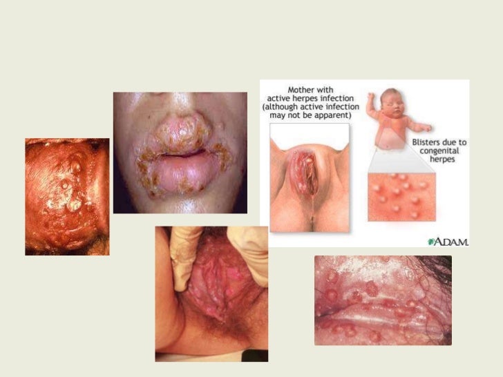 Having sex with someone who has herpes Free mature 3some porn movies